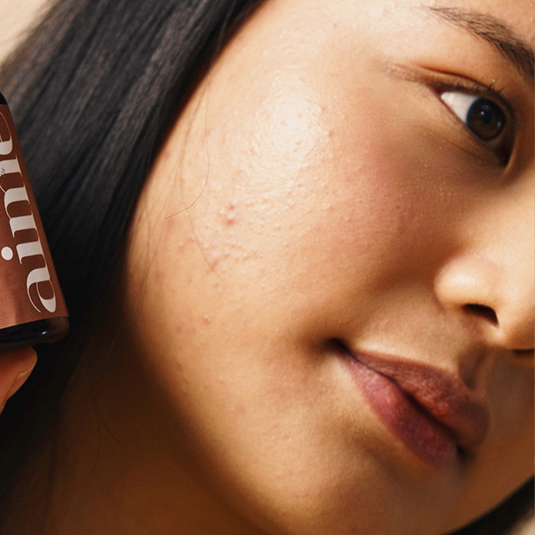 Cicatrices d’acné : comment les atténuer et les éviter ?