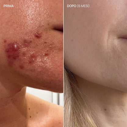 Integratore alimentare acne, Pure Glow 22