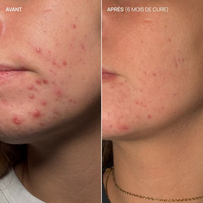 Complément alimentaire imperfections, Pure Glow 5