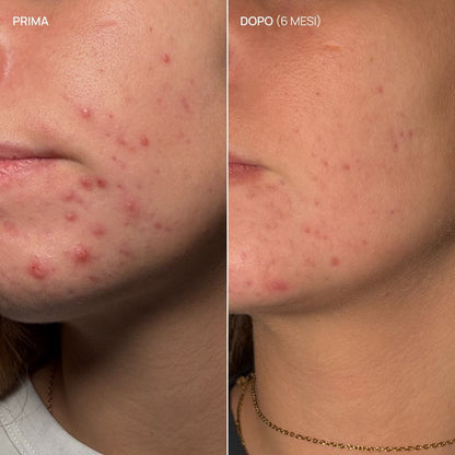 Integratore alimentare acne, Pure Glow 23