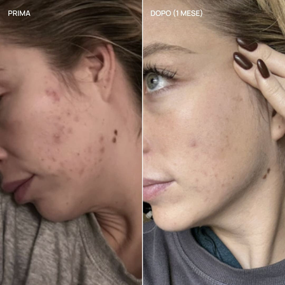 Integratore alimentare acne ormonale, Balance & Glow 