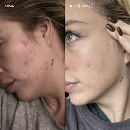 Integratore alimentare acne ormonale, Balance & Glow 27