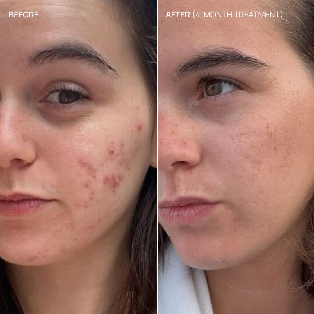 Acne supplement, Pure Glow 