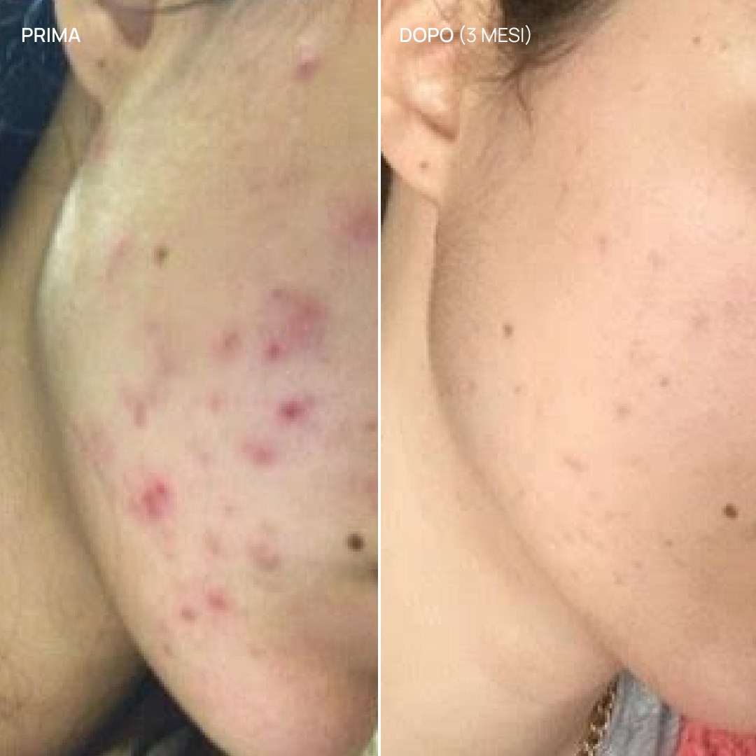Integratore alimentare acne ormonale, Balance & Glow 