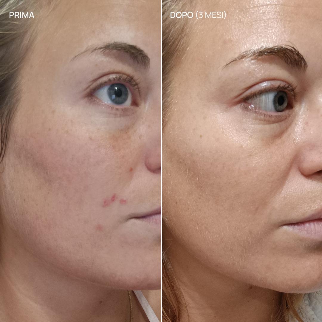 Integratore alimentare acne ormonale, Balance & Glow 