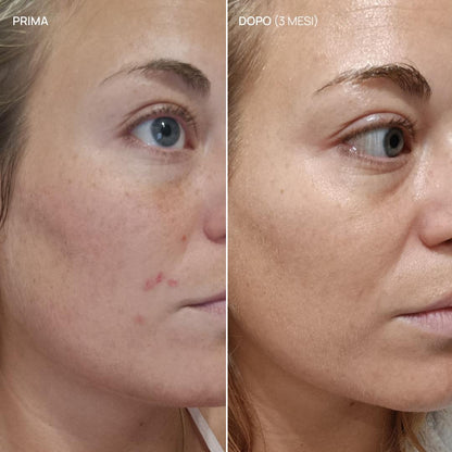 Integratore alimentare acne ormonale, Balance & Glow 22