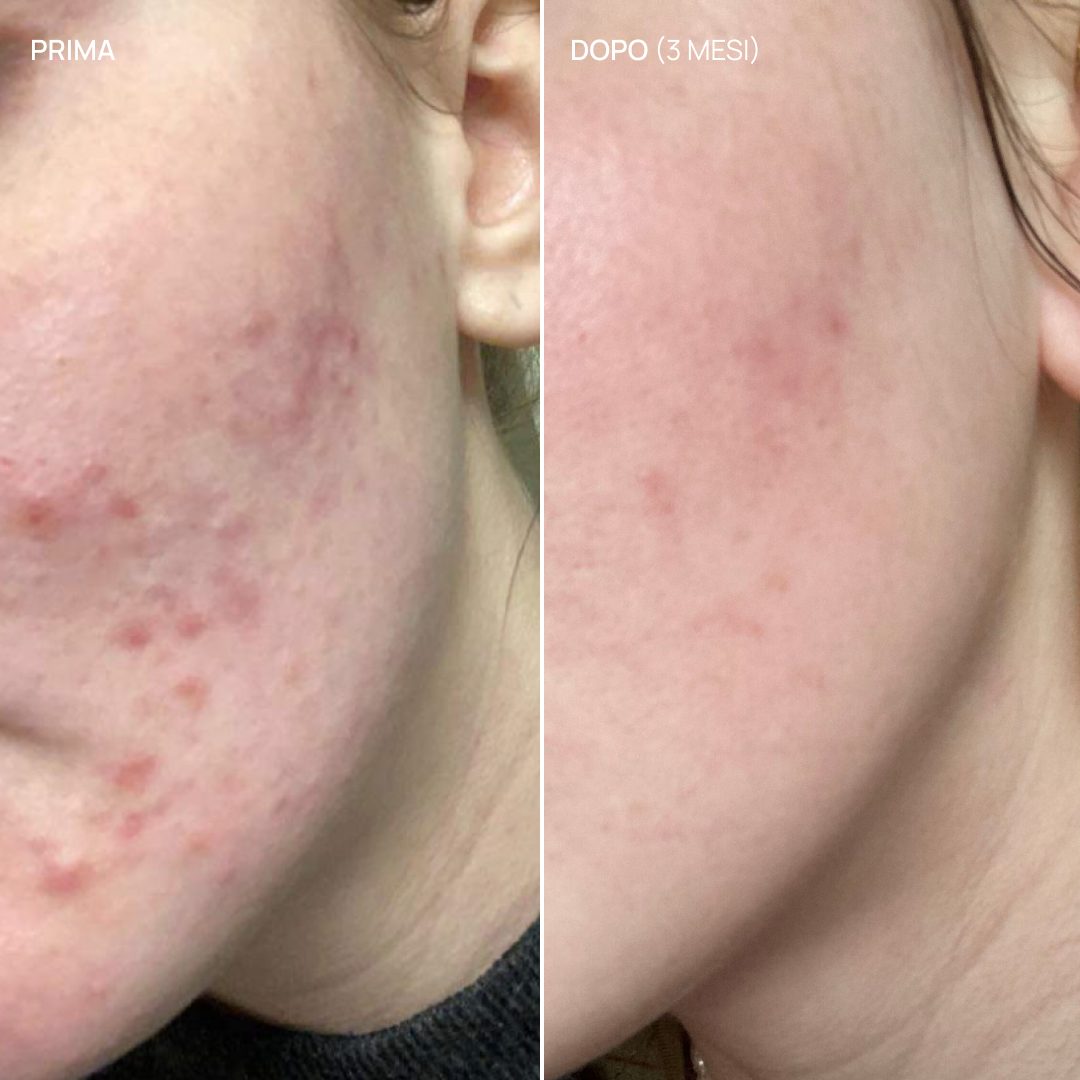 Integratore alimentare acne ormonale, Balance & Glow 