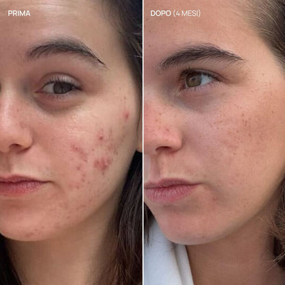 Integratore alimentare acne, Pure Glow 18